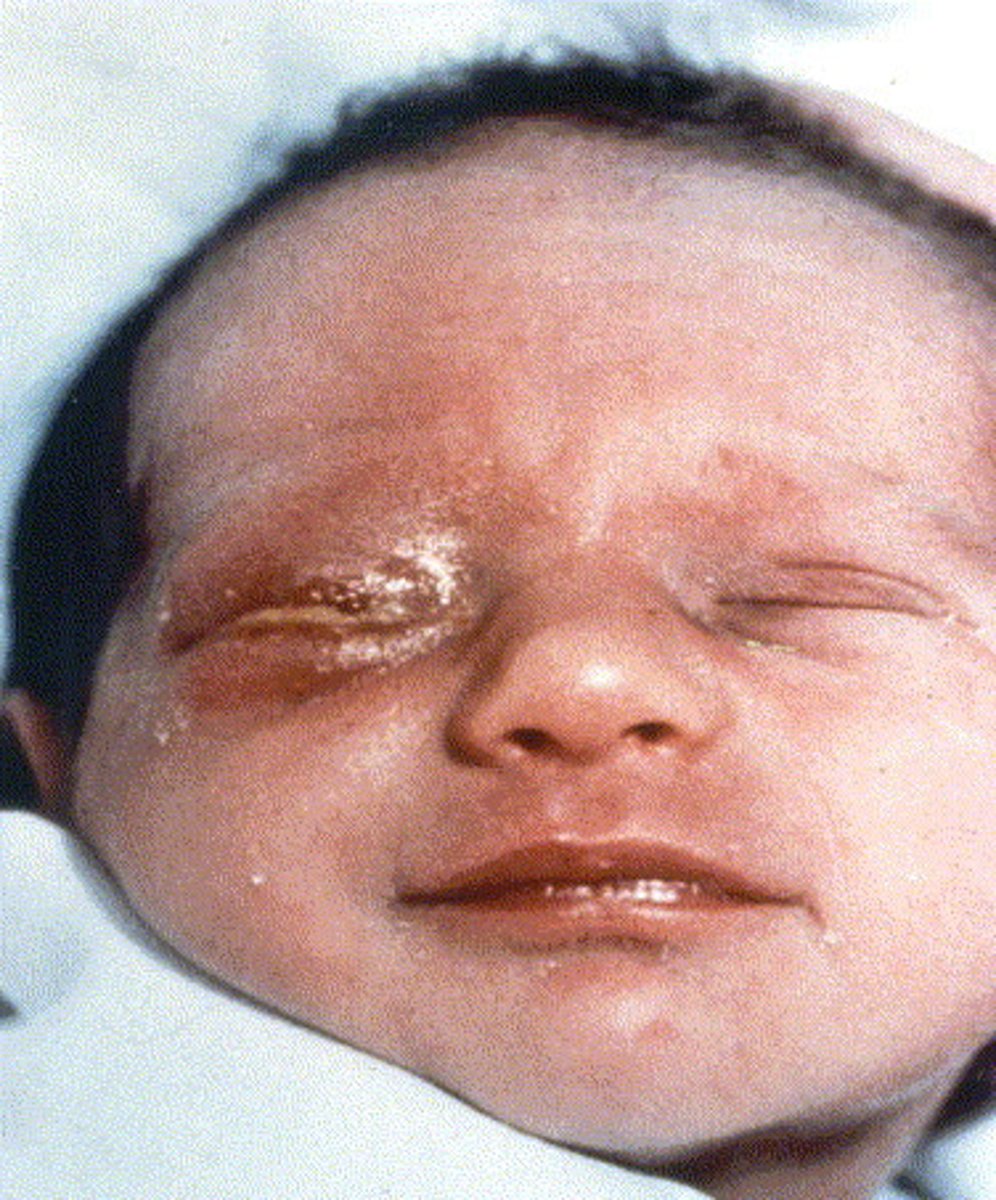 <p>Caused by Neisseria gonorrhoeae, a Gram negative bacterium - may lead to blindness</p><p>Transmitted to a newborn’s eyes during passage through the birth canal</p>