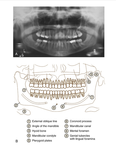 <ul><li><p>single facial bone that forms lower jaw</p></li><li><p>only freely moveable bone of the skull</p></li><li><p><strong>contains the mandibular foramen, mental foramen, and coronoid notch, along with teeth of lower dentition</strong></p></li></ul><p></p>