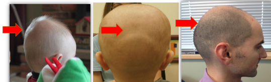 <p>Posterior Fontanel</p>