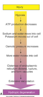 <p>Acute cell swelling</p><p>Causes cytoplasm swelling with extensive vacuolisation</p><p>Due to hypoxia</p><p>Reversible change</p><p>Hepatocytes, pancreatic acinar cells and renal tubular epithelial cells</p><p>(Ballooning degeneration is what occurs in other cell types, like keratinocytes)</p>