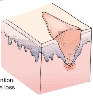 what type of cutaneous wound healing is this?