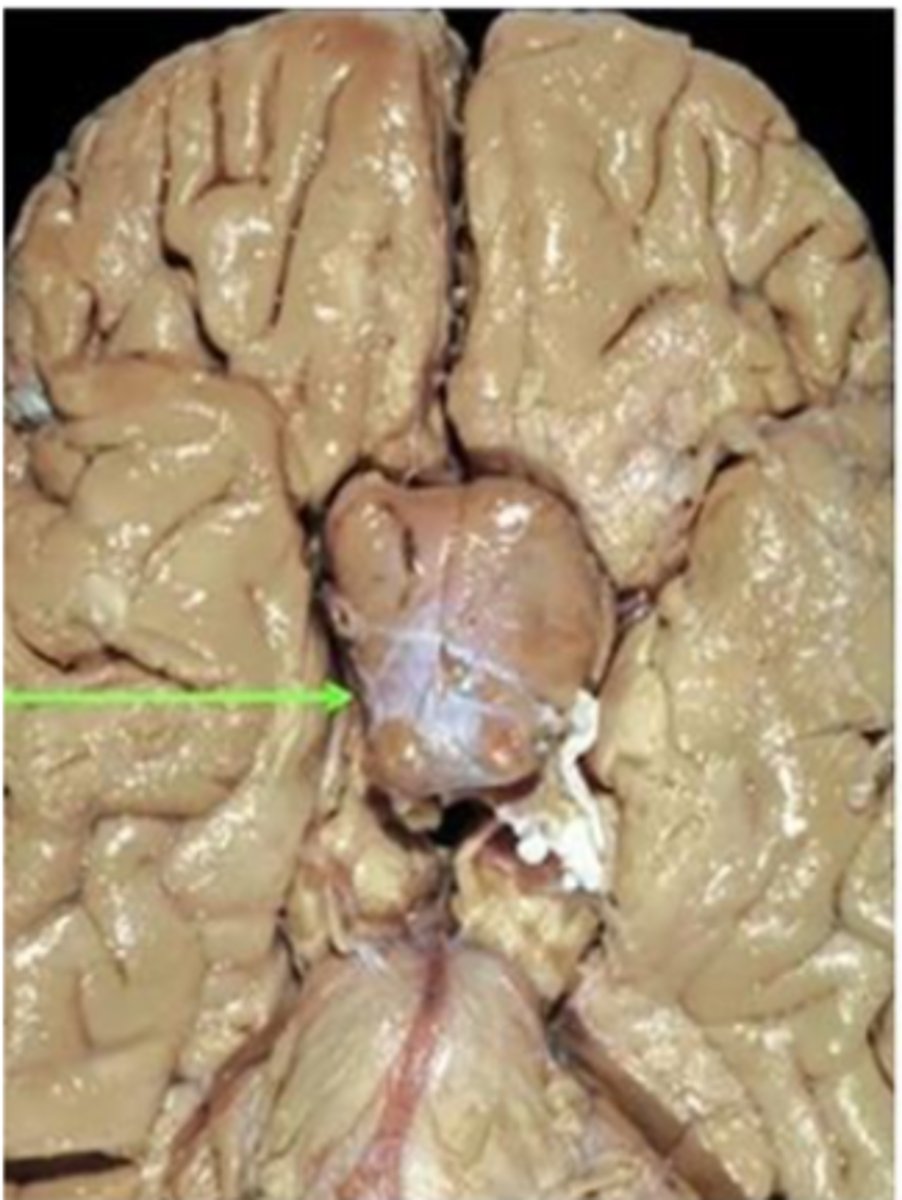 <p>gross pathology of _______ _________</p><p>-tan-to purple in color and creamy in texture</p><p>-macro or micro</p>