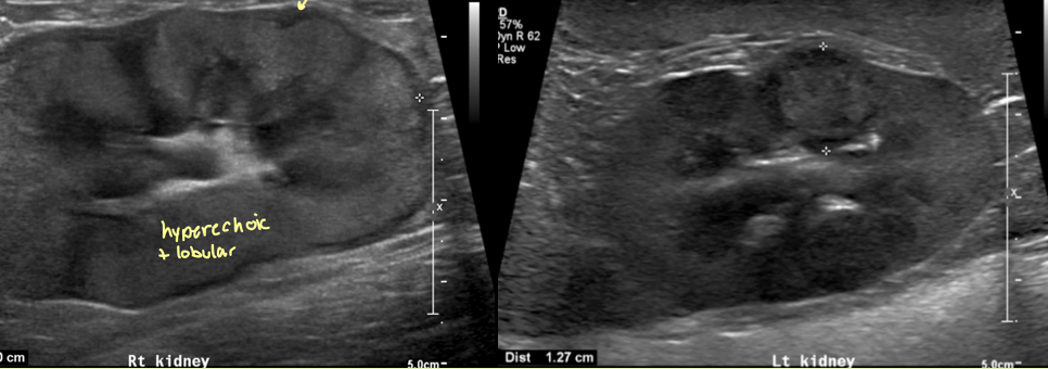 <p>which is more characteristic of lymphoma vs mets</p>