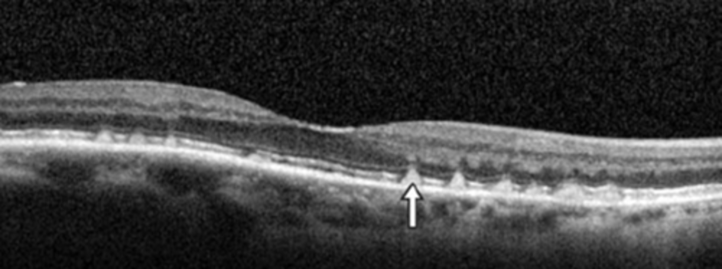 <p>PIL elevation with RPE flat beneath</p>