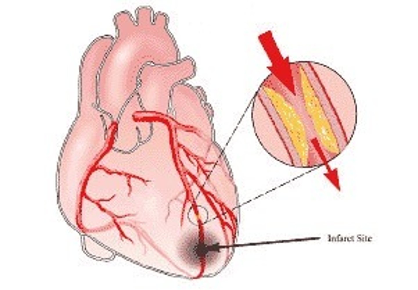 <p>A clot in an unbroken blood vessel<br>Can be deadly in areas like the heart</p>