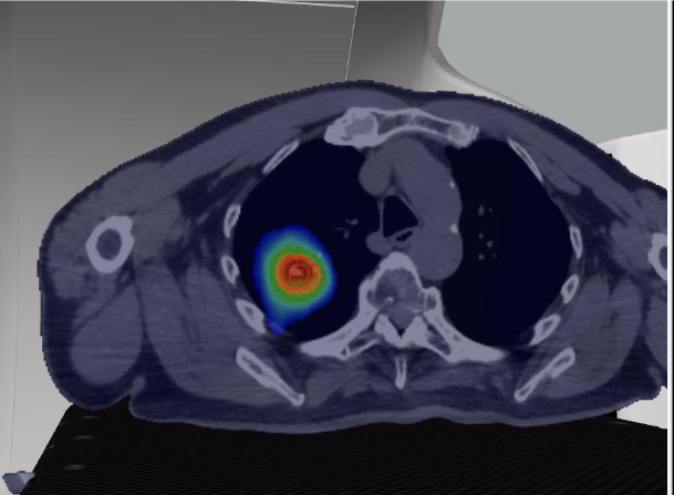 <p>Describe this treatment technique</p>