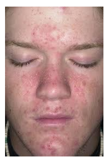<p>what type of eczema is this?</p>