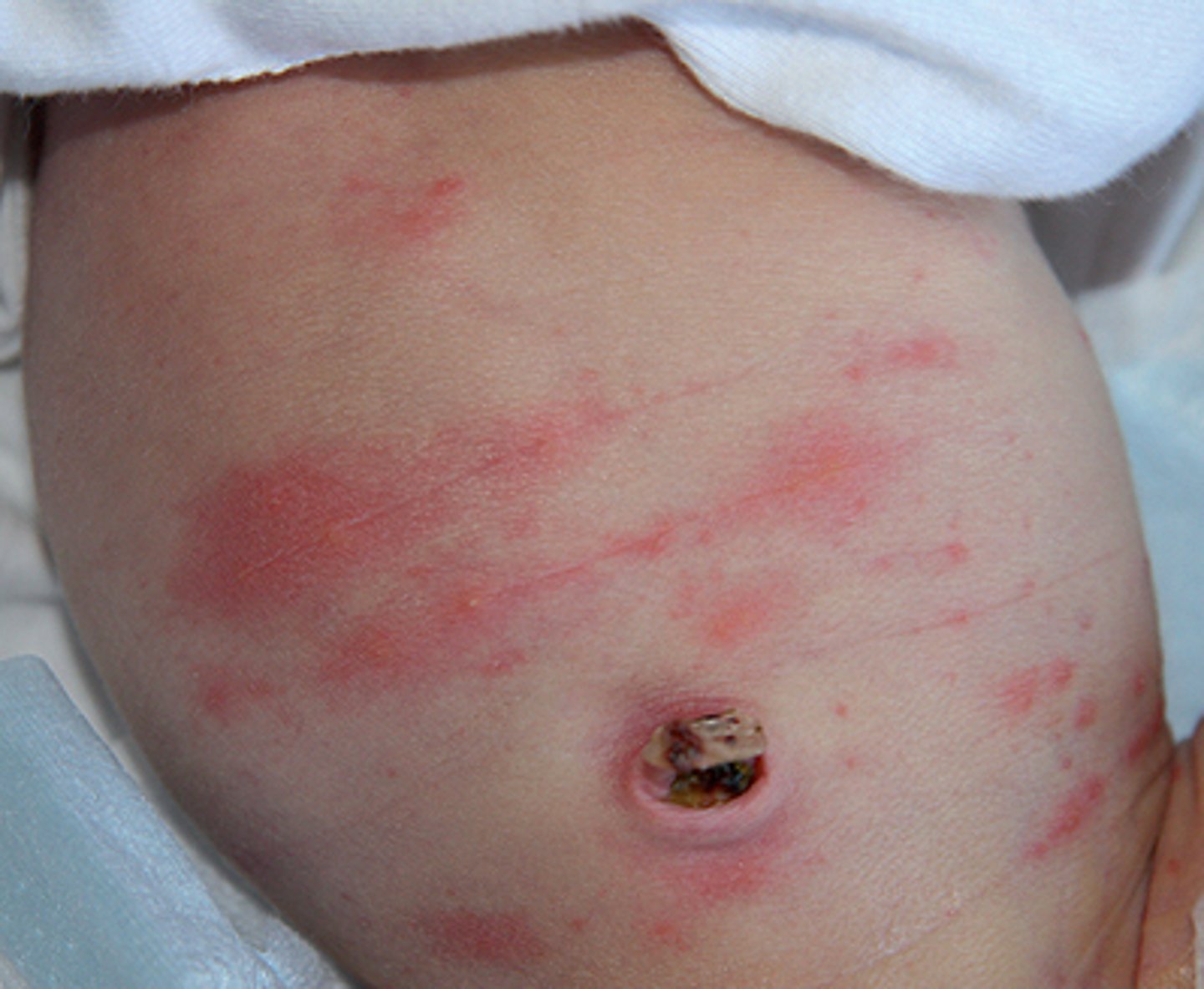 <p>pink rash that appears suddenly anywhere on the body of a term newborn during the first 3 weeks.</p>