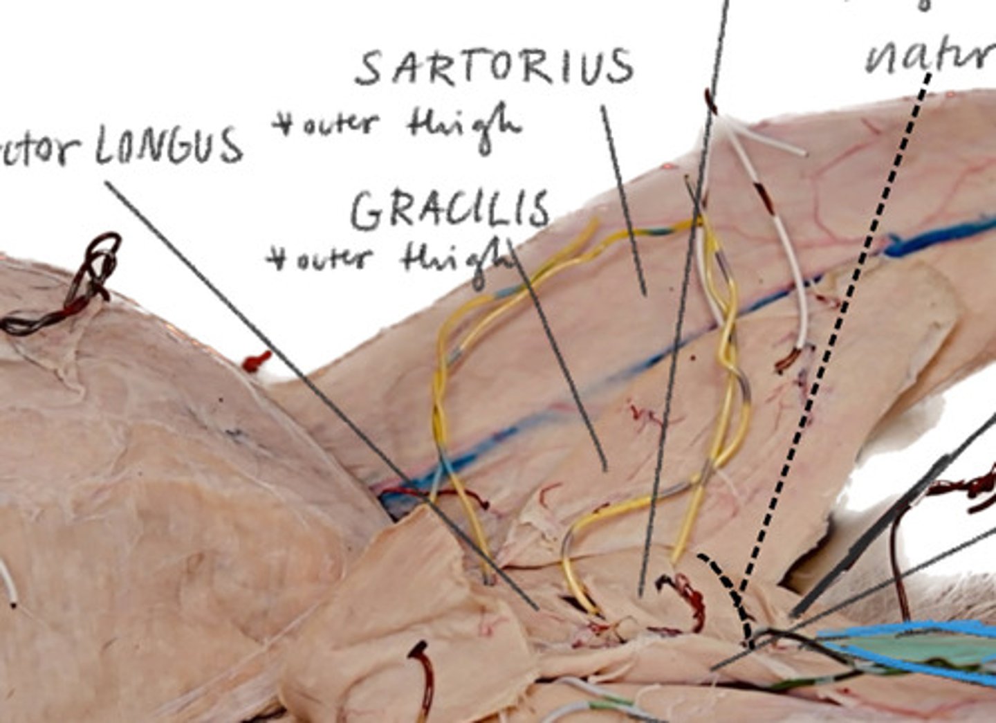 <p>Most lateral leg flap outer thigh</p>