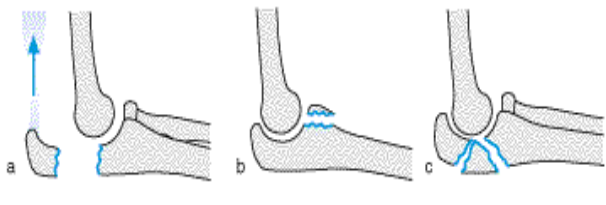 <p>Proximale Ulnafraktur</p>