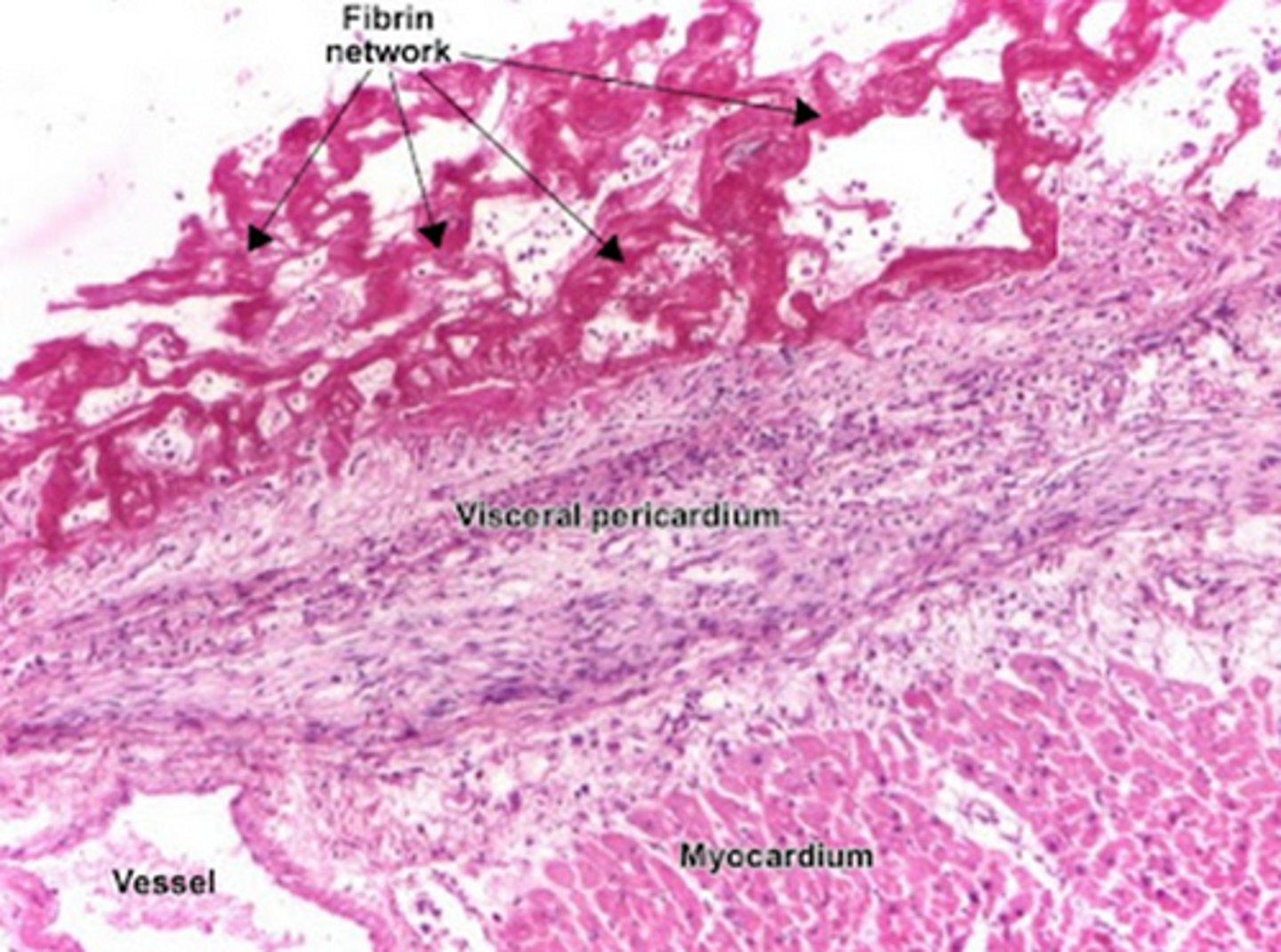 <p>Dressler syndrome</p><p>(autoimmune mediated post-MI fibrinous pericarditis, 2-12 weeks after acute episode)</p>