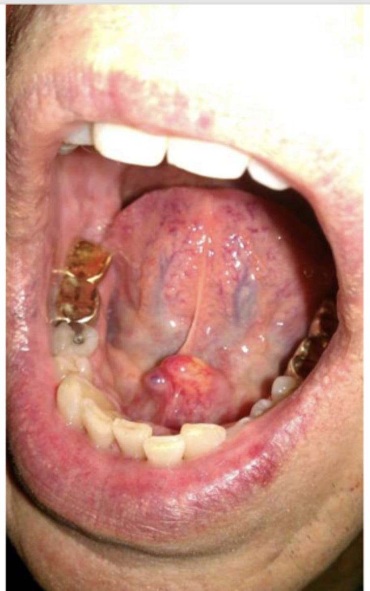 <p>ID the pathology:</p><p>Associated with pain upon salivation</p>