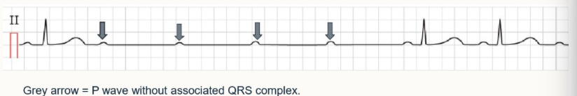 <ol><li><p><strong>delay or disturbance in the transmission of electrical impulses from the atria to the ventricles</strong></p></li><li><p>numerous types - assess the relationship b/w P waves and QRS complexes to diagnose</p></li><li><p>AVN issues - P waves present but not associated with QRS complexes, prolonged PR interval</p></li></ol><p></p>