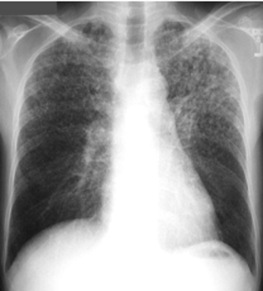 <p>diffuse bilateral infiltrates with very small nodules</p><p>-late phase of TB: potentially fatal form of the disseminated disease due to the hematogenous spread of tubercle bacilli to the lungs, and other organs.</p>