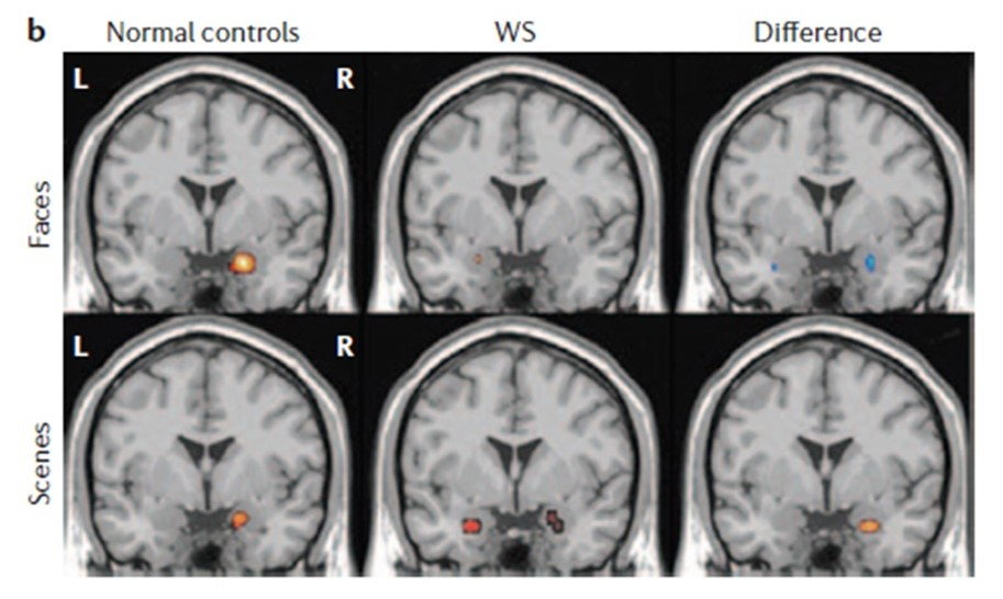 <p>The images above show that in Williams Syndrome (WS), compared to controls,</p><ul><li><p>the dorsal visual stream is more activated when viewing threatening faces</p></li><li><p>the amygdala is more activated when viewing threatening scenes</p></li><li><p>the ventral visual stream is more activated when viewing threatening faces</p></li><li><p>the amygdala is more activated when viewing threatening faces</p></li></ul><p></p>
