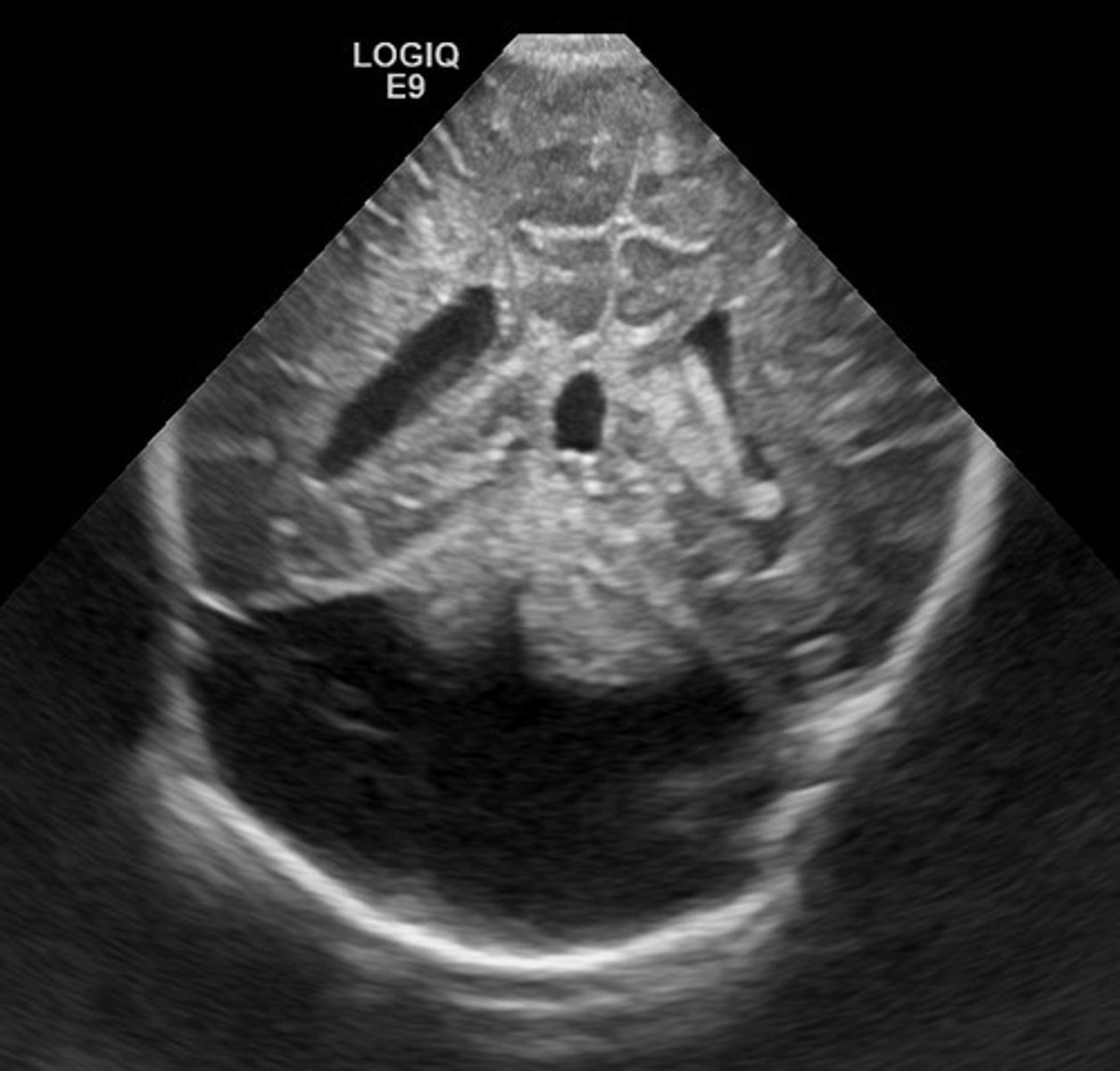 <p>Defect in vermis of cerebellum that dilates the 4th ventricle</p><p>Splaying of cerebral hemispheres - enlarged cisterna magna</p>