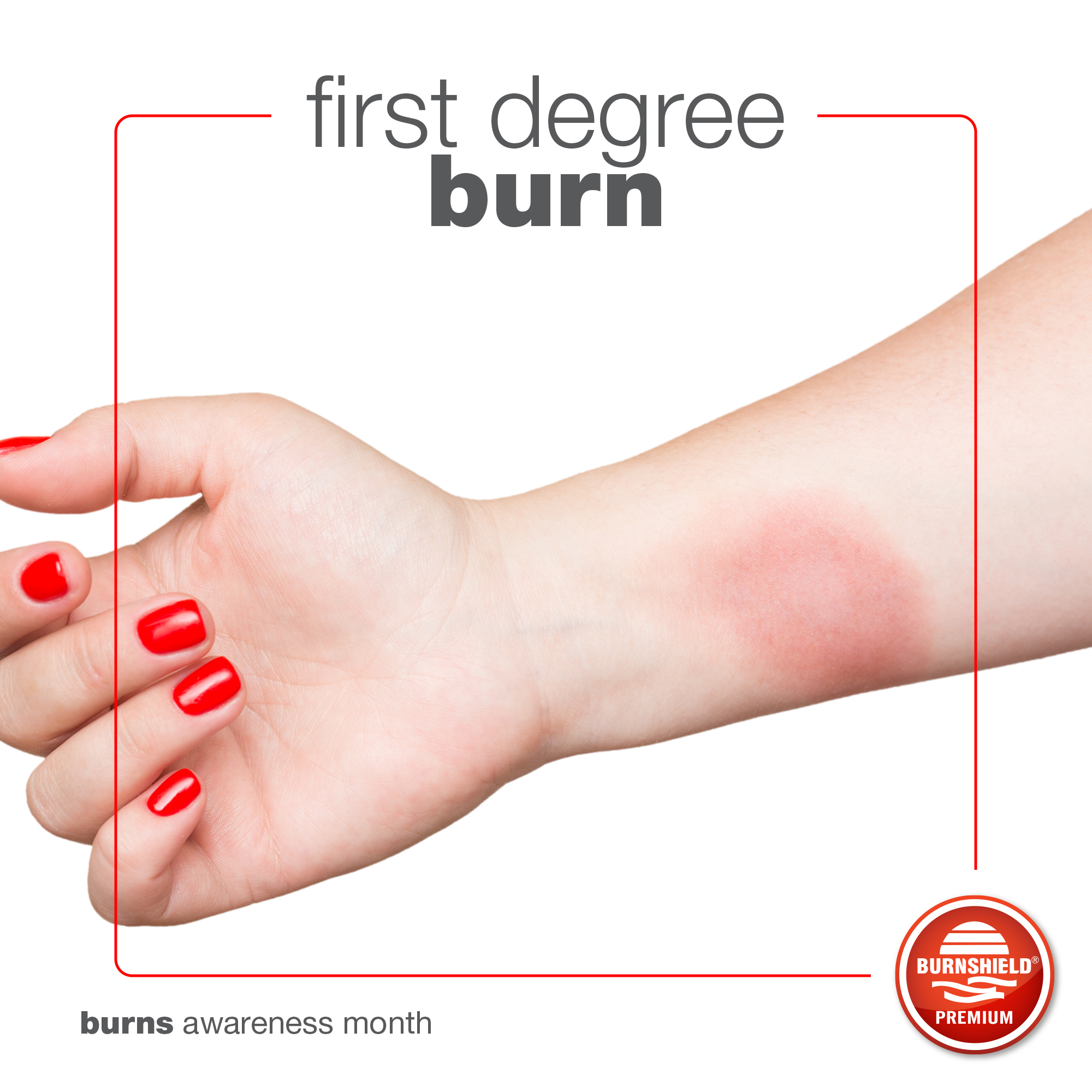 <p>1st degree burn</p>