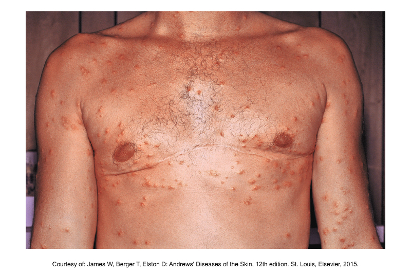 <p>Avian blood flukes are also common and can infect snails and then release cercariae that infect humans who swim in water where aquatic birds are migrating, causing Swimmer’s Itch.</p>