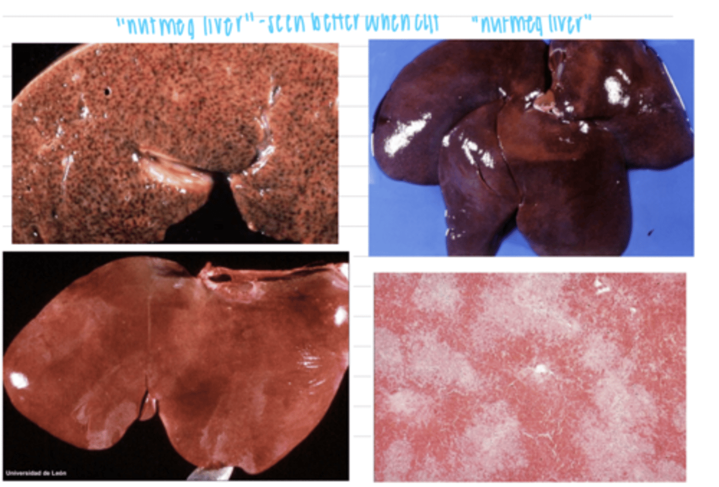 <p>grossly:</p><p>enlarged</p><p>red and yellow- "nutmeg liver"</p><p>softer consistency</p><p>microscopically:</p><p>congestion and dilation of sinusoids</p><p>beginning of fat degeneration</p>