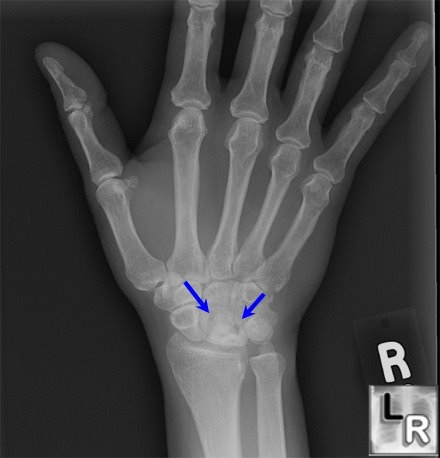 <p>What is Kienböck’s disease?</p>