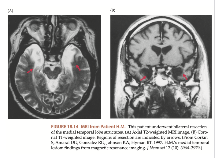<p><strong>verschillende geheugensystemen: </strong>casus H.M.</p>