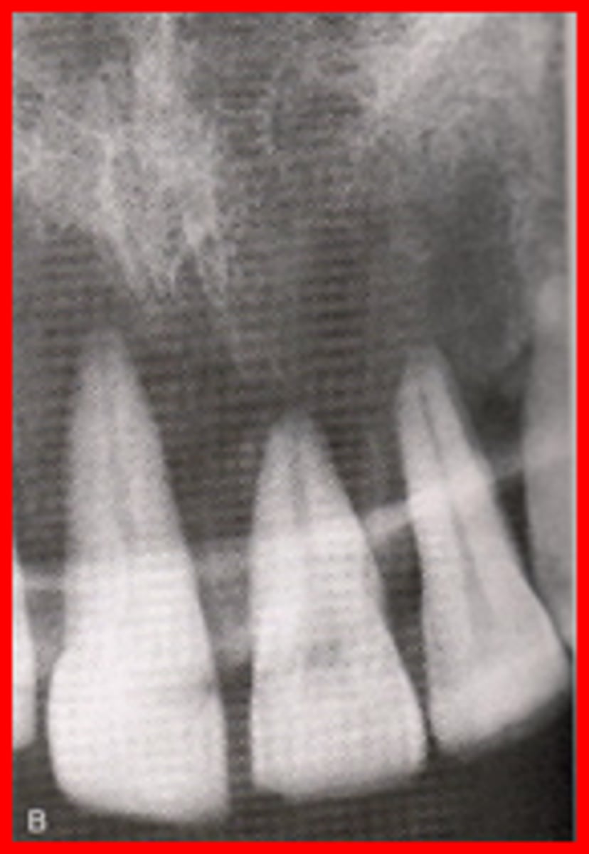 <p>results from excessive vertical angulation</p>