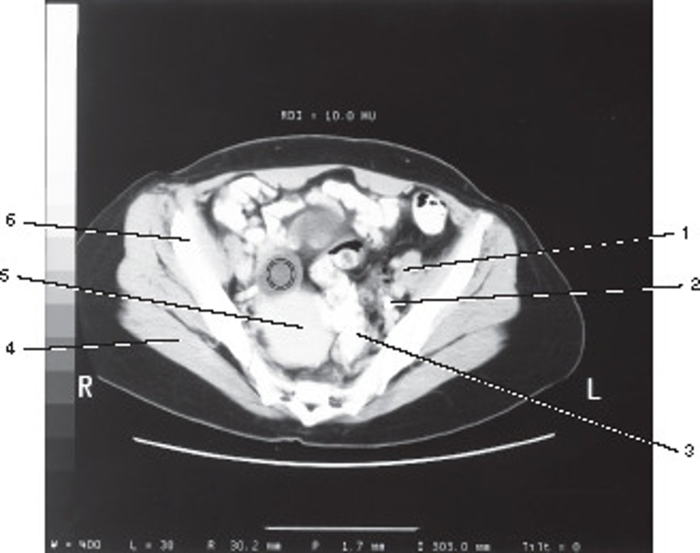 <p>This ROI has a HU value of +10, given its position in a female bony pelvis, this most likely represents:</p>