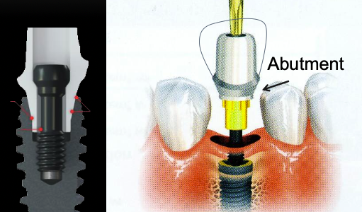 <p>Abutment</p>