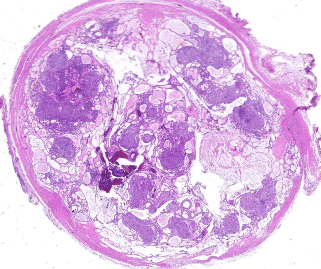 <ol><li><p>well-defined lesion surrounded by thick fibroud capsule </p></li><li><p>tubular or duct-like structures</p></li></ol><p></p>