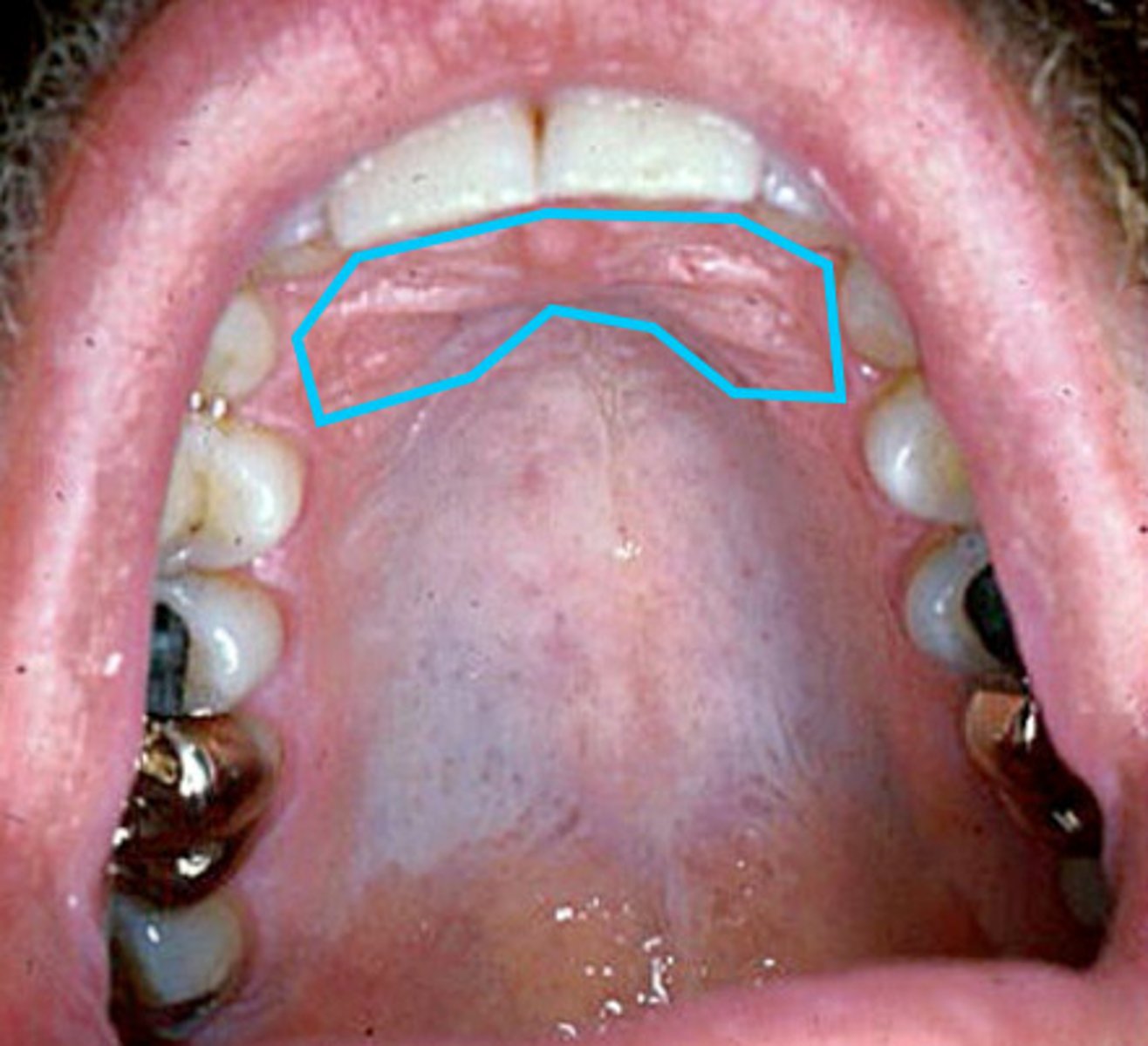 <p>raised area of dense connective tissue in the anterior 1/3 of the palate.</p>