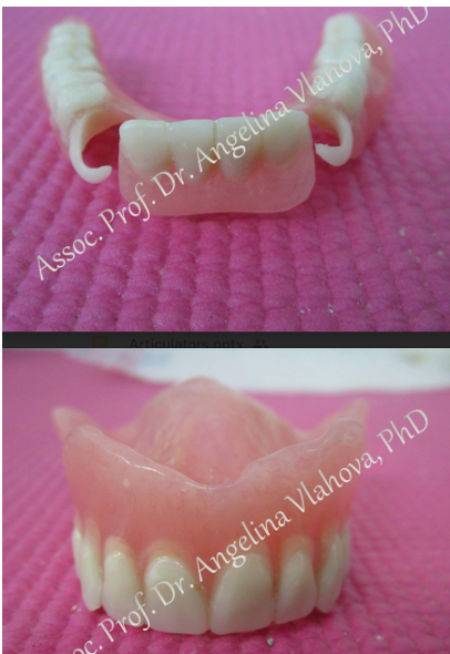 <ul><li><p>any removable dental prosthesis fabricated for placement immediately following removal of natural tooth/teeth </p></li><li><p>Alveolar ridge in upper frontal area </p></li></ul><p></p>
