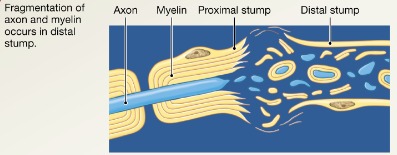 <p>Axon fragments and myelin sheaths distal to injury degenerate (Wallerian degeneration); degeneration spreads down axon</p>