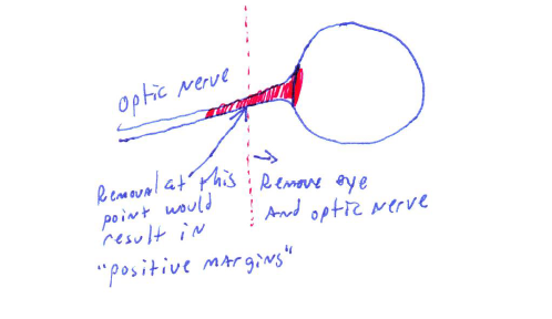 <ol><li><p>To keep the eye</p></li><li><p>If tumor is bilateral (to keep vision)</p></li><li><p>If after surgery, there are positive margins at the optic nerve (pic below) </p></li></ol><p></p>