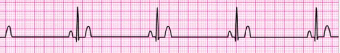 <p>Identify the rhythm.</p>