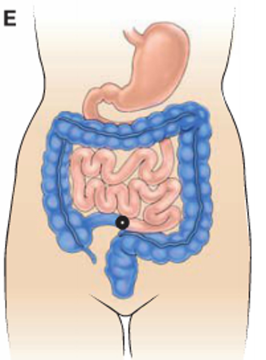 <p>opening from small intestine/ ileum</p><p>output = liquid/ semisolid containing digestive enzyme which can irritate the skin</p><p>protrudes 2-3cm</p>