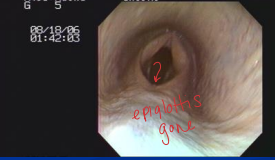 <p><span>Dynamic Airway Obstruction in Horses</span></p>