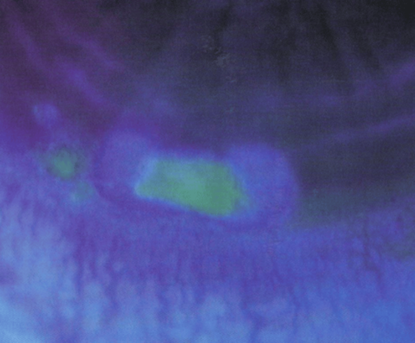 <p>What does this staining pattern over the corneal infiltrates indicate?</p>