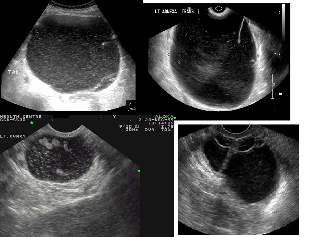 <ul><li><p>elements from endocervix or bowel </p></li><li><p>100 LBS</p></li><li><p>often in 40-70 yrs old</p></li><li><p>benign, common</p></li><li><p>large complex mass</p></li><li><p>20-25%  of all benign ovarian neoplasms</p></li><li><p>5-10% of all malignant ovarian neoplasms</p></li><li><p>15-20% bilateral when malignant</p></li></ul><p></p>