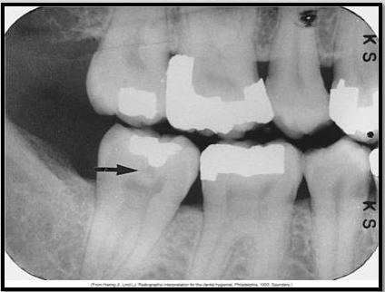 <p>Identify the carious lesion.</p>