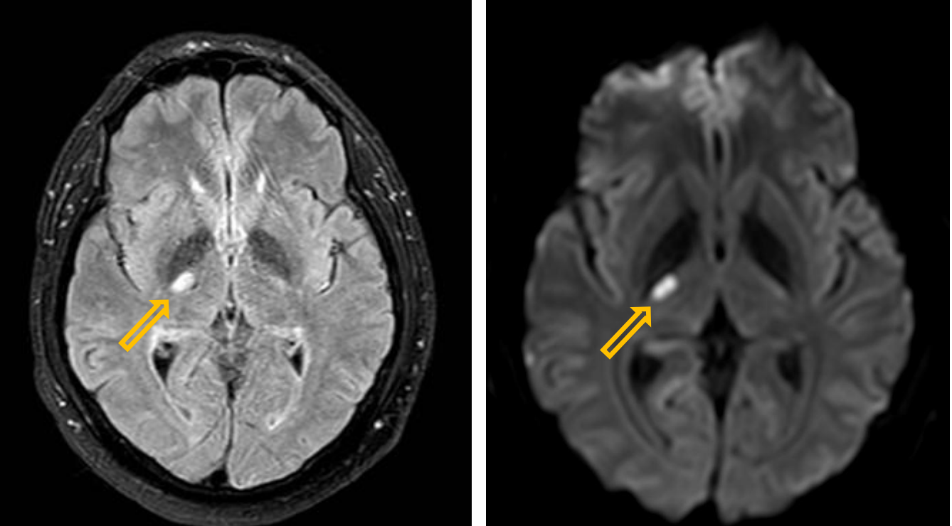 <p>Patient history: at present left-sided hemiparesis (for some hours), with hypertension and diabetes mellitus in patient’s history</p><p>Modality: FLAIR (left) and DWI (right) MRI (noncontrast sequences) Region: brain, axial view</p><p>Radiologic sign: hyperintense lesion representing edema and restricted diffusion in the posterior genu of the right internal capsule</p><p>Diagnosis: small-area acute infarction</p>