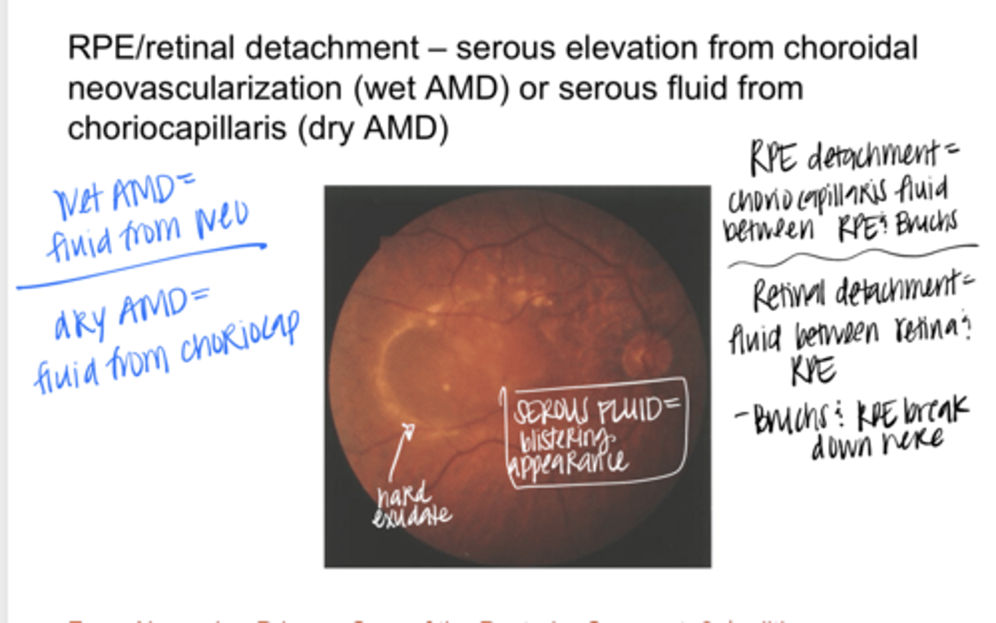<p>DRY AMD Source of Serous Fluid</p>