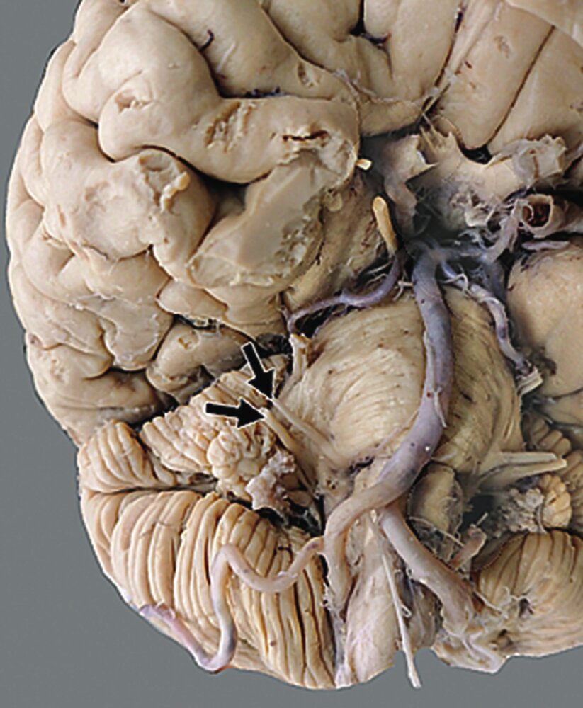 <p>65. Which cranial nerves are marked with arrows?</p><p>(The image shows the brainstem viewed from a lower-back angle — "oblique caudal view.")</p><p>A. N. trigeminus and N. facialis</p><p>B. N. facialis and N. vestibulocochlearis</p><p>C. N. vestibulocochlearis and N. glossopharyngeus</p><p>D. N. glossopharyngeus and N. vagus</p><p>E. N. vagus and N. accessorius</p>