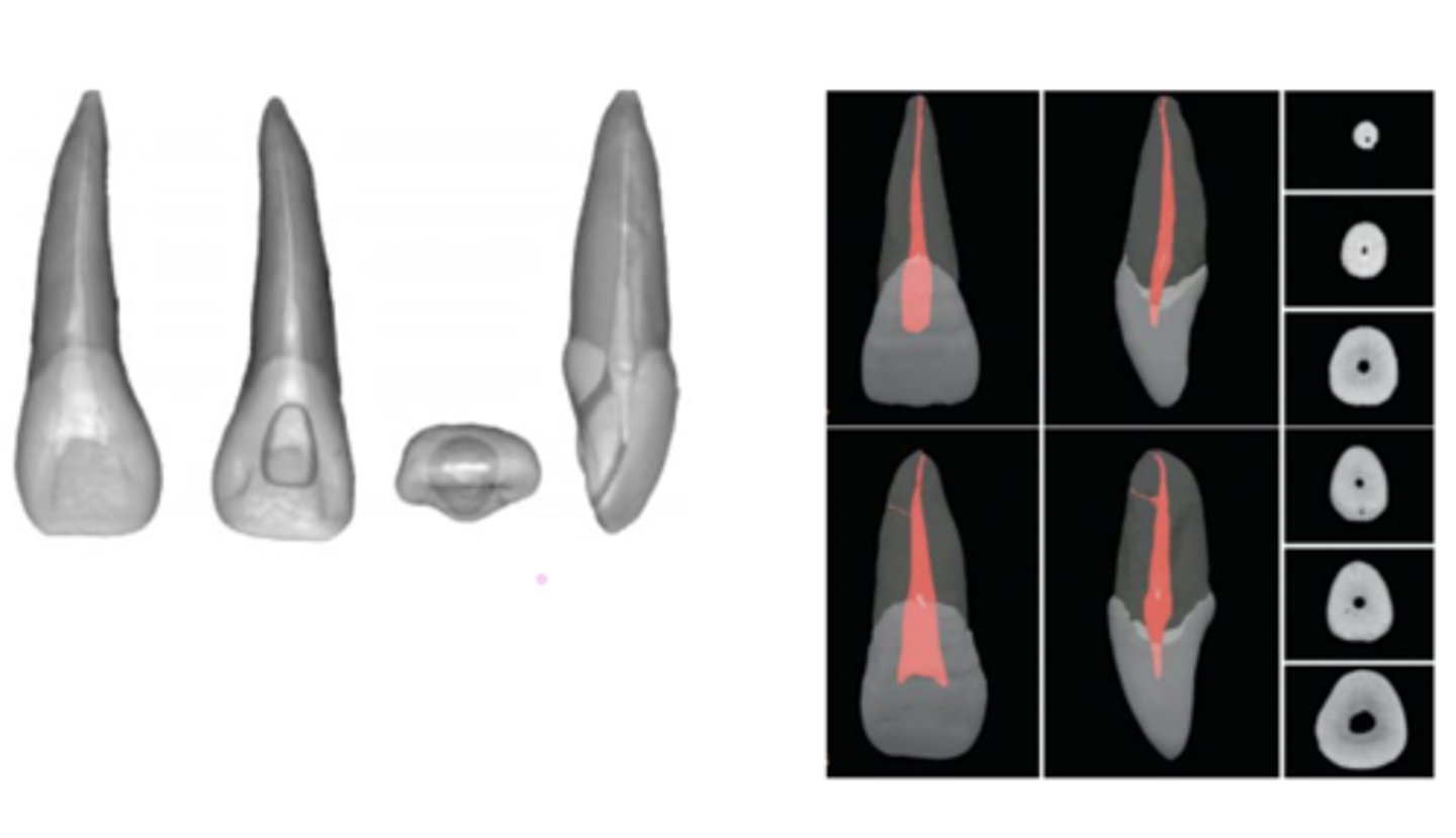 <p>Maxillary central incisor</p>