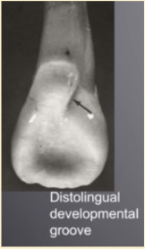 <p><mark data-color="yellow" style="background-color: yellow; color: inherit">maxillary lateral incisors #7 and #10; distal edge</mark></p>
