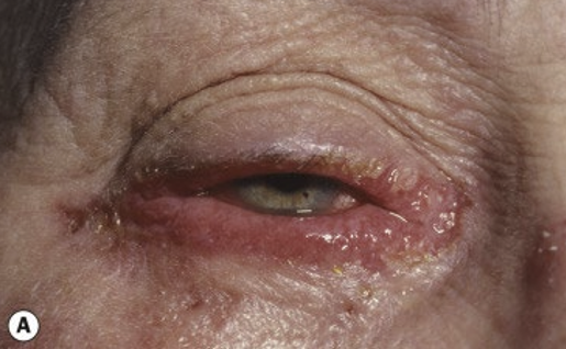 <ul><li><p>Itching</p></li><li><p>Tearing</p></li><li><p>Photophobia</p></li><li><p>Mucoid discharge&nbsp;</p></li><li><p>Tends to be worse than VKC&nbsp;</p></li></ul><p></p>