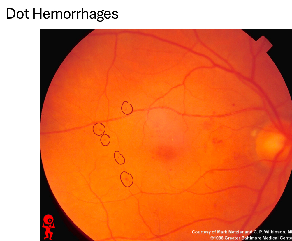 <p>INL, OPL (<u>intraretinal</u>)</p><p>resolves in 3 months</p>