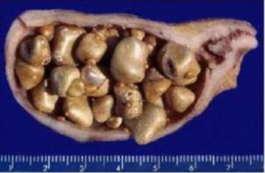 <p>best diagnosis based on the findings </p>