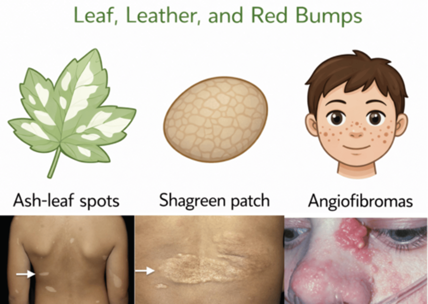 <p>multiple, smooth-surfaced papules primarily in nasolabial fold area</p>