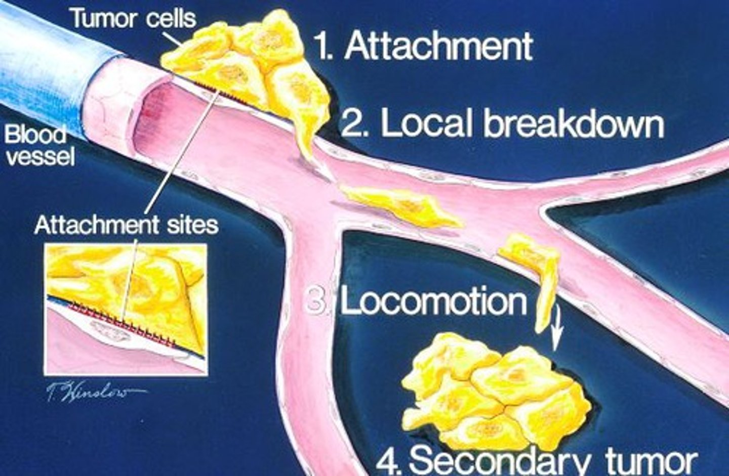 <p>He means that part of your tumor has split off and traveled to another area of your body.</p>