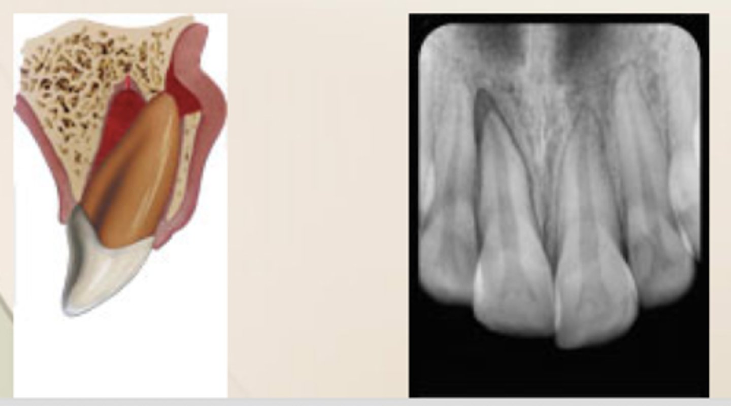 <p>which type of traumatic luxation injury:</p><p>- Displacement of a tooth buccally or lingually</p><p>- Usually accompanied by fracture of socket</p><p>- Usually locked into bone</p><p>- Not tender to touch, not mobile</p><p>Diagnosis:</p><p>- 2+ angulated PA radiographs</p><p>Treatment:</p><p>- Reposition the tooth into normal</p><p>position</p><p>- Confirm with radiograph</p><p>- Stabilize tooth with a flexible splint for 1-2 weeks</p><p>- Follow up</p><p>- Necrotic? → NS-RCT</p>